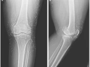 گُھٹنے کے درد میں مبتلا خاتون کی ٹانگ میں سونے کے تار برآمد