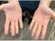 صرف مکھن، پنیر اور گوشت کھانے والے شخص کی جِلد سے چکنائی رسنا شروع