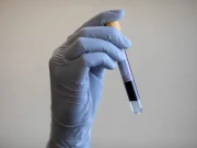 خون کا ایک ٹیسٹ کس بیماری کی بگڑتی کیفیت کی پیشگوئی کر سکتا ہے؟