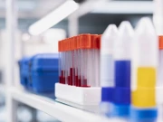 سائنس دانوں نے ٹی بی کے لیے نئی ٹیسٹ ٹیکنالوجی تیار کرلی