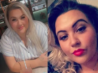 کاسمیٹک سرجری نے 34 سالہ خاتوں کی جان لے لی