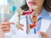 آنتوں کے کینسر کے بڑھتے کیسز، عالمی سطح پر ماہرین میں تشویش