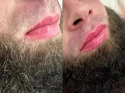 روسی مردوں میں لِپ فِلرز مقبولیت حاصل کرنے لگے