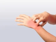 کراچی میں شدید گرمی کے باعث جلدی امراض میں اضافہ