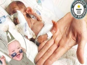 صابن جتنے وزن والے انتہائی لاغر بچے کو طبی سائنس نے بچا لیا