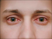 کراچی میں آشوب چشم کی وبا پھیل گئی، مریضوں میں اضافہ