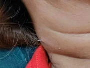 کھانے کے دوران مچھلی کی ہڈی گردن سے باہر نکل آنے کا عجیب و غریب واقعہ