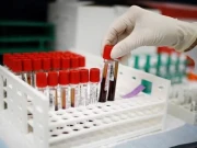 سائنسدانوں نے فرانسیسی خاتون میں نیا بلڈ گروپ دریافت کرلیا