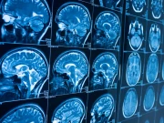 دل کی بیماری دماغی حجم کو کم کرسکتا ہے، تحقیق