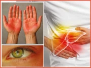 کہیں آپ بھی جگر کی بیماری کا شکار تو نہیں؟