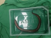 چین میں شہری کے پیٹ سے زندہ بام مچھلی برآمد