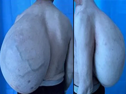 چین: کمر کا کامیاب آپریشن، تین نومولودوں کے وزن کے برار گانٹھ نکال دی