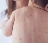 سندھ میں خناق نے خطرے کی گھنٹی بجادی، 1 درجن سے زائد بچے جاں بحق