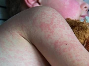 عالمی سطح پر خسرہ کے کیسز میں 20 فی صد اضافے کا انکشاف