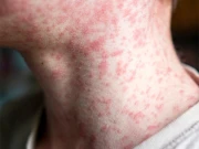 برطانیہ سے ’خسرہ سے پاک‘ ملک کا اسٹیٹس واپس لے لیا گیا