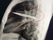 شہری کو سینے میں چبھن کی شکایت، معائنے میں ڈاکٹر وجہ جان کر حیران رہ گئے