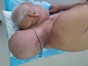 16 سال تک علاج کرانے سے انکاری شہری کی گردن میں رسولی سر جتنی بڑی ہوگئی