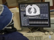 سگریٹ نہ پینے والوں میں کینسر شناخت کرنے والا اے آئی ماڈل