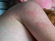 رواں برس بھی سندھ میں خسرہ کی وباء میں تشویشناک حد تک اضافہ