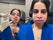 لِپ فلرز ختم کروانے پر عرفی جاوید کا چہرہ بگڑ گیا، ویڈیو وائرل