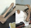 سندھ میں منکی پاکس کا ایک اور مشتبہ کیس، حالت تشویشناک