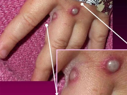 نوزائیدہ بچوں میں ایم پاکس کے کیسز، ماہرین کا انتباہ