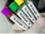 پاکستان ٹی بی ادویات کیخلاف مزاحم مریضوں کے حوالے سے دنیا کا چوتھا ملک