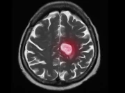 دماغ تک پہنچ جانے والے چھاتی کے کینسر کا علاج مشکل کیوں ہوتا ہے؟