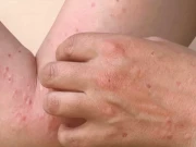 منکی پاکس کی تشخیص اور علاج