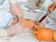 اسٹیم سیل ٹرانسپلانٹ کب ضروری ہوتا ہے؟