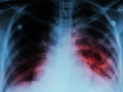 گزشتہ برس عالمی سطح 80 لاکھ سے زائد ٹی بی کے کیسز کا انکشاف