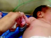 ہولی فیملی اسپتال میں نومولود بچی کا انگوٹھا کٹنے کا واقعہ؛ خاتون نرس ذمہ دار قرار