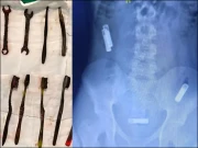 نوجوان کے معدے سے 7 ٹوتھ برش اور رینچ نکل آئے، ڈاکٹرز حیران