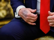 خطرناک بیماری کی علامت؟ ٹرمپ کے دوسرے ہاتھ پر بھی پریشان کن داغ نمایاں