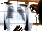 عالمی ادارہ صحت نے ٹی بی کی تشخیص کیلئے نیا ٹیسٹ متعارف کرادیا