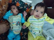 کراچی: دو ماہ کی دھڑ جڑی بچیوں کا کامیاب آپریشن