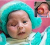 الشفاء آئی اسپتال میں نومولود کی آنکھ سے 285 گرام رسولی کامیابی سے نکال دی گئی