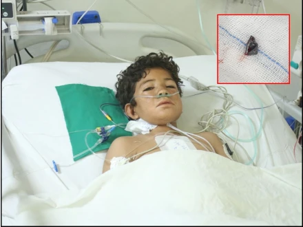 این آئی سی وی ڈی کراچی نے دل میں پیوست گولی نکال کر 12 سالہ بچے کی جان بچالی