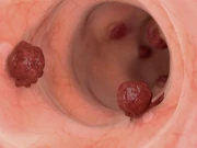 آنتوں کے کینسر میں مبتلا افراد یہ ایک کام کرکے طویل زندگی جی سکتے ہیں