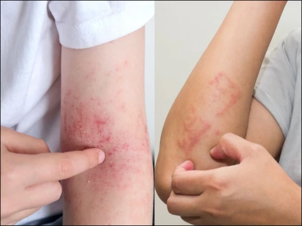 سردیوں کی خارش اور ایگزیما میں فرق کیسے کریں؟ ڈرماٹولوجسٹ کیا کہتے ہیں؟