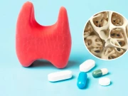 تھائیرائیڈ کی عام دوا ہڈیوں کی کمزوری سے منسلک ہوسکتی ہے، ماہرین